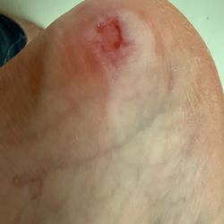 Natural Nail Spa - The chunk taken out of my foot when the owner was using the pumice stone'd my foot without paying attention