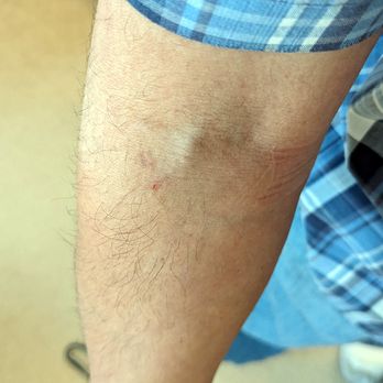 Quest Diagnostics - That red dot is the injection site where I got blood work done at Quest Diagnostics in Chino. The needle didn't touch my vein. - Laboratory Testing Near Me - Chino, California
