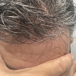 Hair Replacement - Hair system natural hairline and scalp appearance