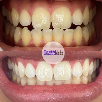 Teeth Whitening Lab - Teeth Whitening Near Me - Long Beach, California Teeth Whitening Lab - Teeth Whitening Near Me - Long Beach, California