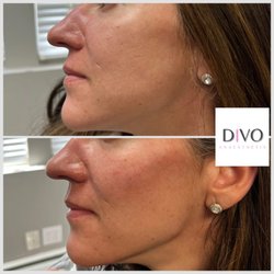 Divo Anaesthetix - Cheekbone and jaw sculpting with Radiesse and Restylane Lyft