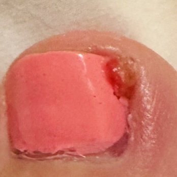 Eclipse Nail Bar - Deep cut into my toe skin now left with blood and a big clump of skins that is severely hurt - Nail Salons Near Me - San Jose, California Eclipse Nail Bar - Deep cut into my toe skin now left with blood and a big clump of skins that is severely hurt - Nail Salons Near Me - San Jose, California