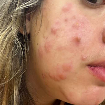 Shore Point Cottages - Bed bug bites on face - Vacation Rentals Near Me - Berlin, Maryland