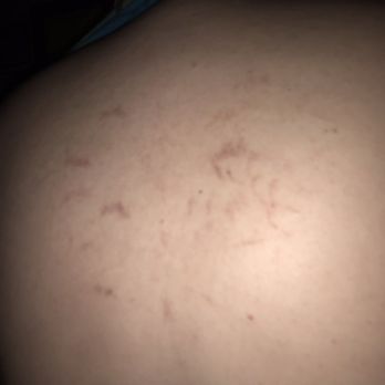 Happy Foot - Bruises on my back - Massage Near Me - Murphy, Texas Happy Foot - Bruises on my back - Massage Near Me - Murphy, Texas
