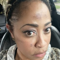 BioDerm Skincare & Laser Center - Chemical burns