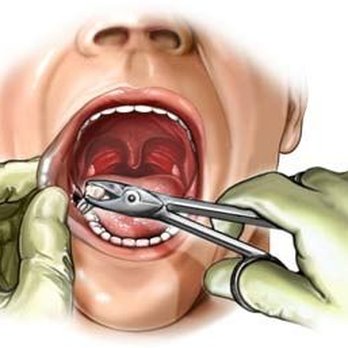Gregory B Sweeney, DDS - Extraction - General Dentistry Near Me - North Syracuse, New York Gregory B Sweeney, DDS - Extraction - General Dentistry Near Me - North Syracuse, New York
