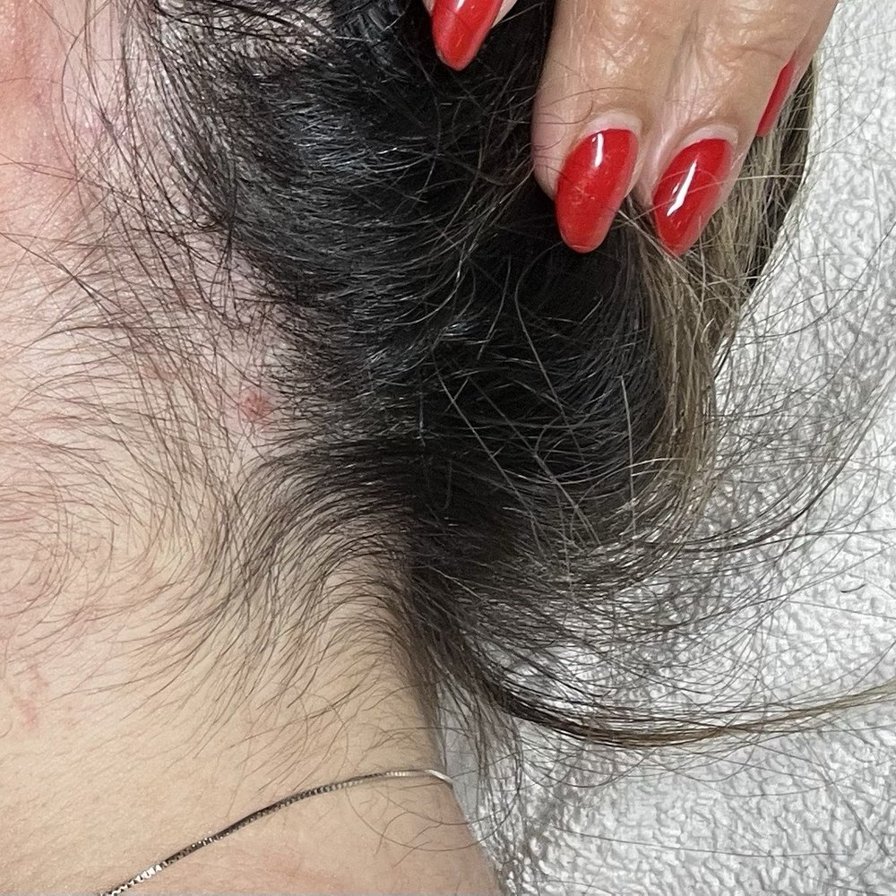 Electrolysis By Zabil - Immediately before my first session. - Hair Removal Near Me - Glendale, California