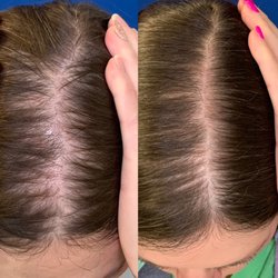 RejuvLA SKIN + HAIR - Before and after double PRP with Acell and topical compounded minoxidil for Telogen Effluvium.  This is 4 months after initial treatment.
