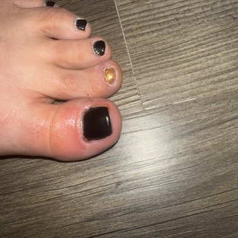 Classy Nails and Spa - Burn left big toe - Waxing Near Me - Canton, Georgia