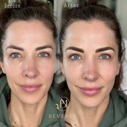 Beverly Microblading Center - Ombre Brows & Lash Liner Cover up old eyebrows (before is not our work) before|After  done by Master Artist Mahsa Bahaelou