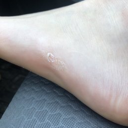 Dead skin on left foot. Dead skin on left foot.