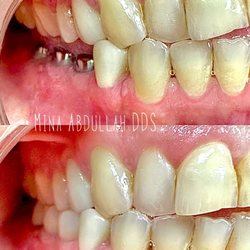 Jamacha Dental - Implant by doctor Alkaseer at Jamacha dental in El cajon
