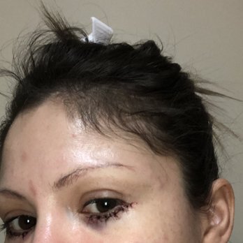 Ryan A. Stanton, MD - Lower eyelid pinch with bruising day 1 - Cosmetic Surgeons Near Me - Los Angeles, California