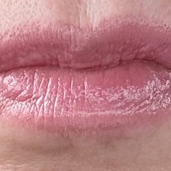 Breazeale Clinic For Plastic Surgery - Before Lip Flip