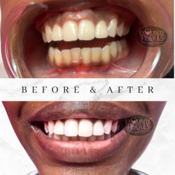 Exquisite Pearls Teeth Whitening