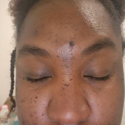 Hand & Stone Massage and Facial Spa - How the burns looked on Monday