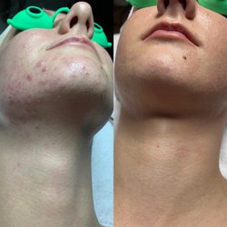 Client's Acne & Scarring gone using Morris Code Beauty® Advanced Aesthetics Skin Care Products & Services