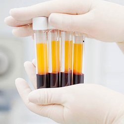 Needles & Tox - PRP=Platelet Rich Plasma. We spin your own blood in a centrifuge to separate out that liquid gold which stimulates skin and hair restoration