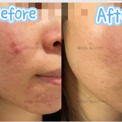 Mosa Beauty - Picosurepro