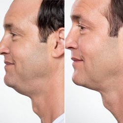 Aesthetic and Cosmetic Plastic Surgery Center - Kybella Injection before & after on male