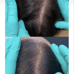 Renewlogie Med Spa - Hair restoration at Renewlogie with PRP injections and Pepfactor microneedling. Series of 3 recommended.