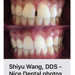 Shiyu Wang, DDS - Nice Dental - Aligner treatment . Finished within a few months. Photo provided by our patient.