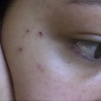 Bae's Skin Care - Healing process involves scabbing but nothing too bad - Cosmetics & Beauty Supply Near Me - Lakewood, Washington