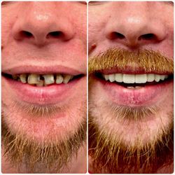 Desoto Dentures and Implants - Before and after