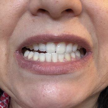 Precision Orthodontics - Results after treatment, my upper teeth are not aligned and are crooked - Orthodontists Near Me - Auburn, California Precision Orthodontics - Results after treatment, my upper teeth are not aligned and are crooked - Orthodontists Near Me - Auburn, California