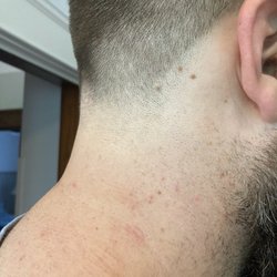 Eddy's Barbershop - Razor rash closeup.