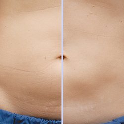 Bare Med Spa - Body Contouring