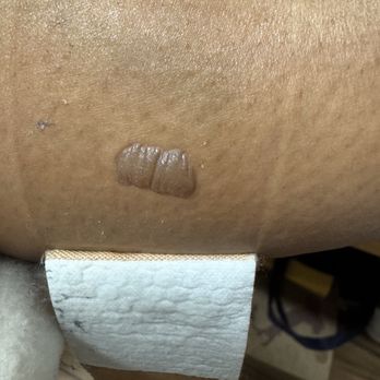 New You Laser - Painful burn due to faulty equipment - Laser Hair Removal Near Me - New York, New York