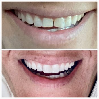 Mesa Dental - Ugly BEFORE vs fabulous AFTER - Cosmetic Dentists Near Me - San Diego, California
