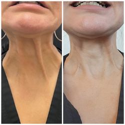 Ajliss Medical Aesthetics - Pasadena - Platysma Muscle