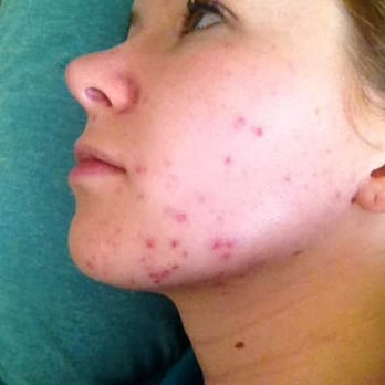 Radiant Threading & Skin Care Spa - My face two days after my facial with Jamila, during which she used excessive force. My skin was previously intact. - Waxing Near Me - Carrollton, Texas