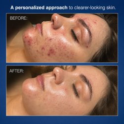 Results achieved in six months. Esthetics by Roxanne, for results: 415.655.9769