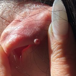 Lovisa - Right Ear Keloid infection