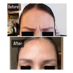 Micari Aesthetics & Veins - Treat those stubborn "11" lines with our wrinkle relaxers. Botox or Dysport.