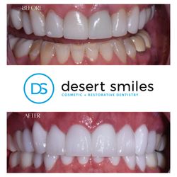 Desert Smiles Cosmetic and Restorative Dentistry - Patient didn't like her dark front tooth and that her lower teeth were worn down and discolored.  We were able to fix all that for her!