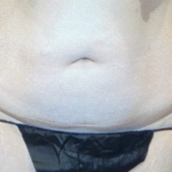 A.J. Khalil, MD - For reference here is a photo prior to surgery. - Cosmetic Surgeons Near Me - Beverly Hills, California