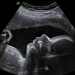 Baby Bump Ultrasound