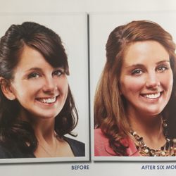 Palos Verdes Dental Care - 6 Month Smiles... Straight Teeth. Less Time. Clear Braces.