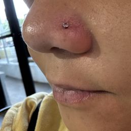 Nose piercing with titanium stud.