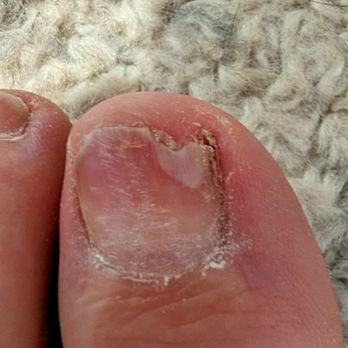 Venetian Nail Spa - Toe Nail Fungus - Nail Salons Near Me - Delray Beach, Florida Venetian Nail Spa - Toe Nail Fungus - Nail Salons Near Me - Delray Beach, Florida
