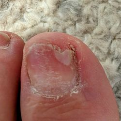 Venetian Nail Spa - Toe Nail Fungus