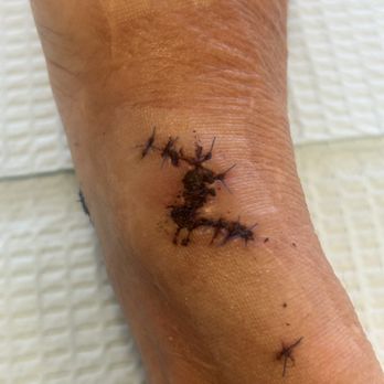 David Kulber, MD - Repair to tendons in wrist, with fat injections to protect the area and promote healing - Surgeons Near Me - Los Angeles, California David Kulber, MD - Repair to tendons in wrist, with fat injections to protect the area and promote healing - Surgeons Near Me - Los Angeles, California