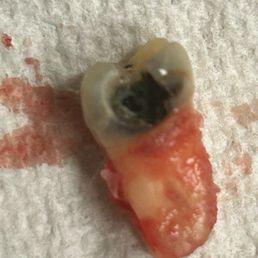 Bad decay and not being responsible tooth extraction