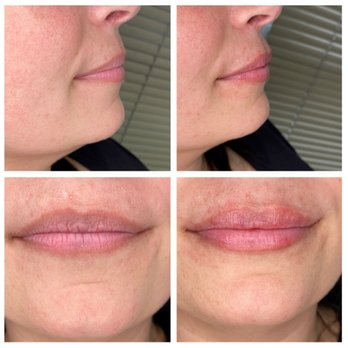 Flawless Aesthetics - Lip filler - Weight Loss Centers Near Me - Columbus, Georgia Flawless Aesthetics - Lip filler - Weight Loss Centers Near Me - Columbus, Georgia