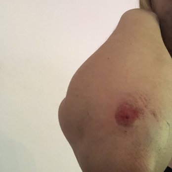 Ride Rite - Painful deep cuts on my elbow from my fall - Driving Schools Near Me - Los Angeles, California