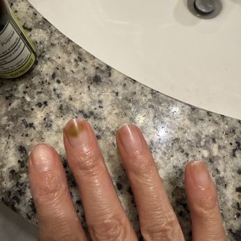 Fantastic Nails - Cleaned it up as much as I could... now to let it heal naturally - Nail Salons Near Me - Orange City, Florida Fantastic Nails - Cleaned it up as much as I could... now to let it heal naturally - Nail Salons Near Me - Orange City, Florida